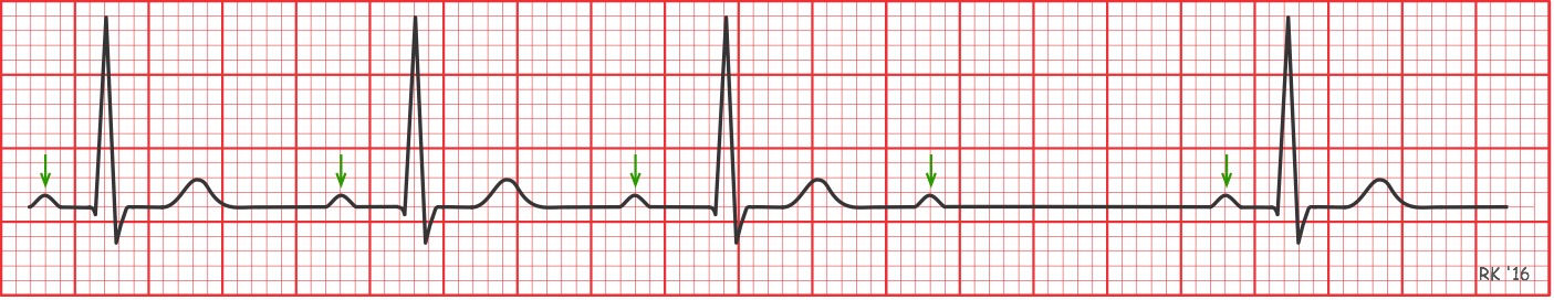 Second degree type 1 AV block